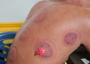 Diduga Salah Penanganan, Konsumen Alami Luka Usai Terapi Bekam