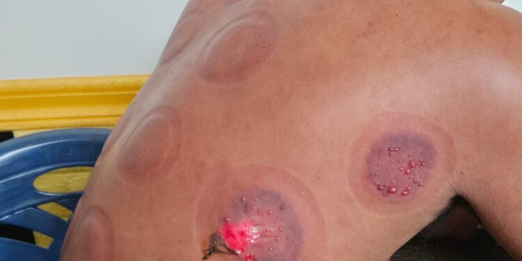 Diduga Salah Penanganan, Konsumen Alami Luka Usai Terapi Bekam